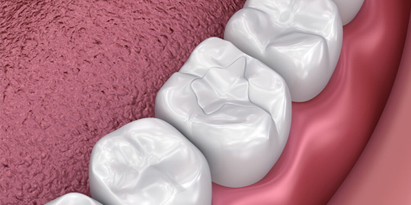 Three white dental crowns displayed on pink gum model showing tooth restoration procedure.