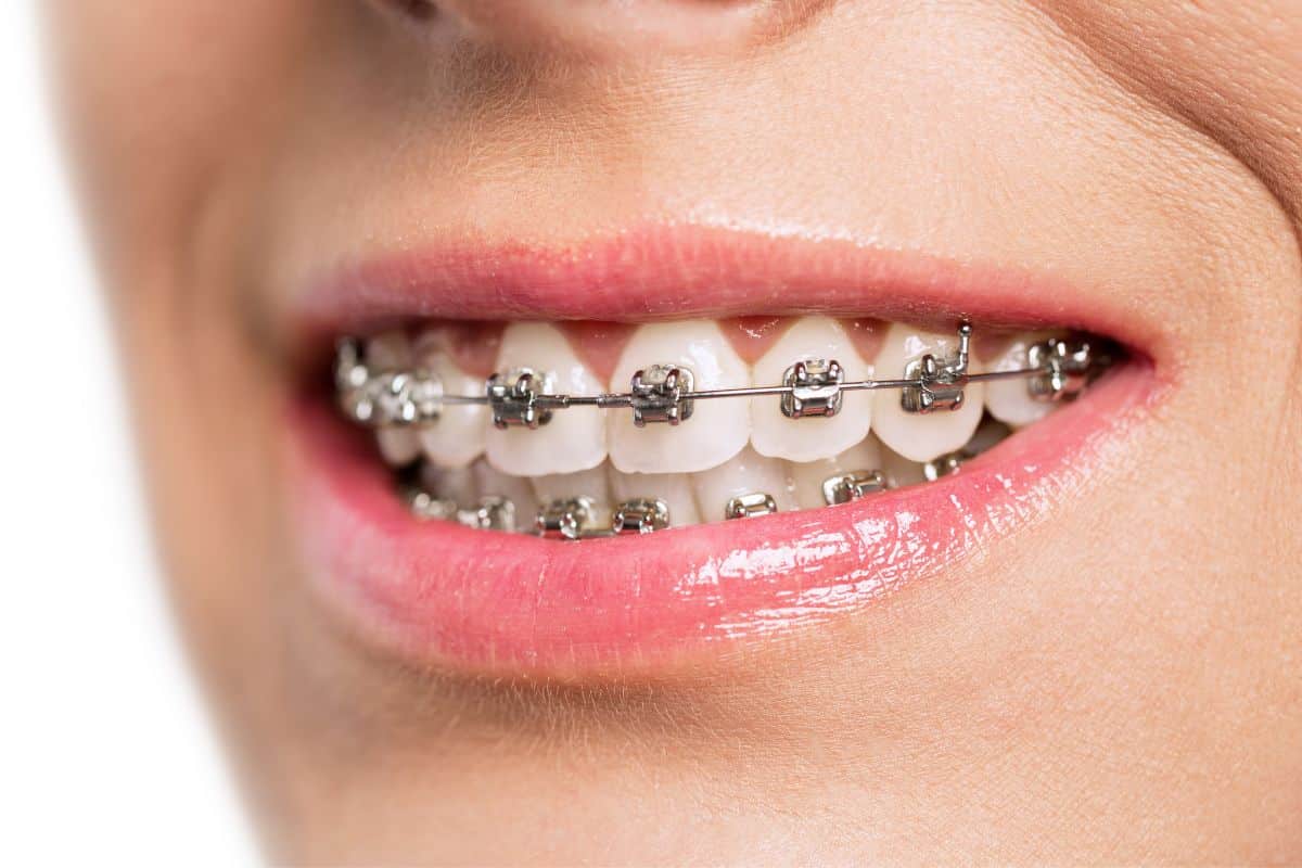 Braces Are Damaged